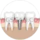 Dental Implant 600x600 cutout from Dental Implant