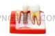 Dental Implant #259 cutout from Dental Implant