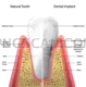 Dental Implant 495x499 cutout from Dental Implant