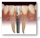 Dental Implant #265 cutout from Dental Implant
