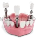 Dental Implant #268 cutout from Dental Implant