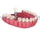 Dental Implant #277 cutout from Dental Implant