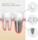 Dental Implant #280 cutout from Dental Implant