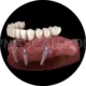 Dental Implant #304 cutout from Dental Implant