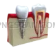 Dental Implant #310 cutout from Dental Implant