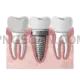 Dental Implant #312 cutout from Dental Implant