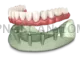 Dental Implant #322 cutout from Dental Implant