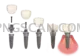 Dental Implant #339 cutout from Dental Implant