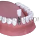 Dental Implant #346 cutout from Dental Implant