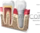 Dental Implant #349 cutout from Dental Implant