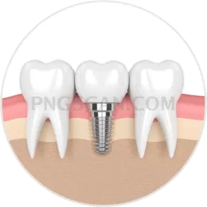 Dental Implant 600x600 cutout from Dental Implant