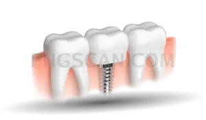 Dental Implant 936x547 cutout from Dental Implant