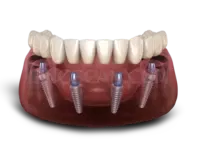 Dental Implant 800x600 cutout from Dental Implant