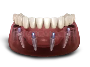 Dental Implant 800x600 cutout from Dental Implant
