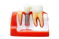 Dental Implant #259 cutout from Dental Implant