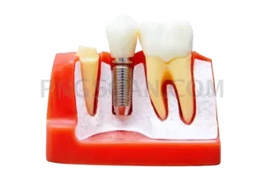 Dental Implant #259 cutout from Dental Implant