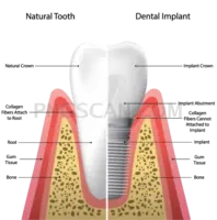 Dental Implant 495x499 cutout from Dental Implant