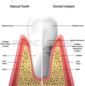 Dental Implant 495x499 cutout from Dental Implant