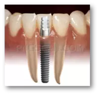 Dental Implant #265 cutout from Dental Implant
