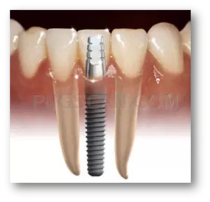 Dental Implant #265 cutout from Dental Implant