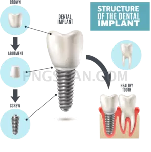 Dental Implant natural cutout from Dental Implant
