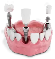 Dental Implant #268 cutout from Dental Implant