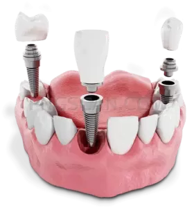 Dental Implant #268 cutout from Dental Implant