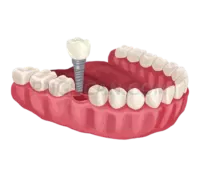 Dental Implant #277 cutout from Dental Implant