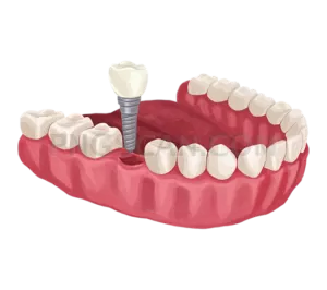 Dental Implant #277 cutout from Dental Implant