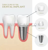 Dental Implant #280 cutout from Dental Implant