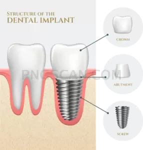Dental Implant #280 cutout from Dental Implant