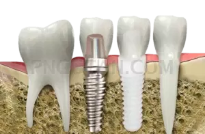 Dental Implant #289 cutout from Dental Implant