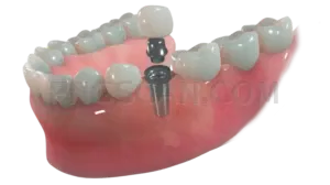 Dental Implant #294 cutout from Dental Implant