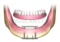 Dental Implant #301 cutout from Dental Implant