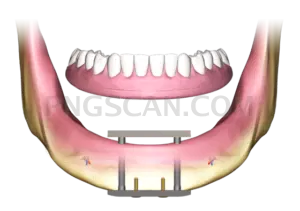 Dental Implant #301 cutout from Dental Implant