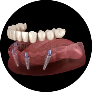 Dental Implant #304 cutout from Dental Implant