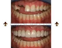 Dental Implant #307 cutout from Dental Implant