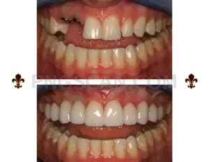 Dental Implant #307 cutout from Dental Implant