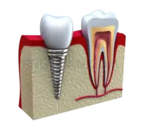 Dental Implant #310 cutout from Dental Implant
