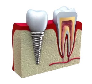 Dental Implant #310 cutout from Dental Implant