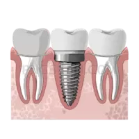 Dental Implant #312 cutout from Dental Implant