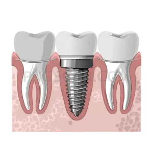 Dental Implant #312 cutout from Dental Implant