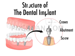Dental Implant #318 cutout from Dental Implant