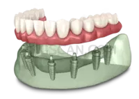 Dental Implant #322 cutout from Dental Implant