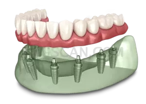 Dental Implant #322 cutout from Dental Implant