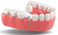 Dental Implant #324 cutout from Dental Implant