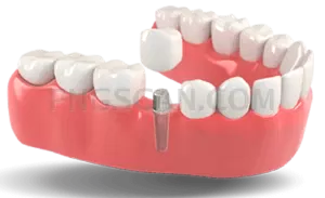 Dental Implant #324 cutout from Dental Implant