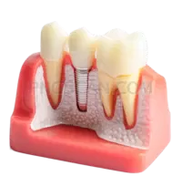 Dental Implant #327 cutout from Dental Implant