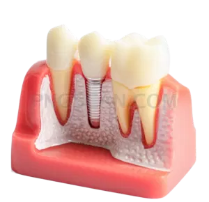 Dental Implant #327 cutout from Dental Implant