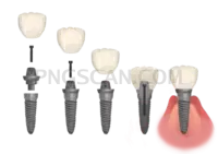Dental Implant #339 cutout from Dental Implant
